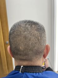 体验前-大麦微针植发全国连锁