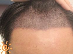 -大麦微针植发丨全国连锁