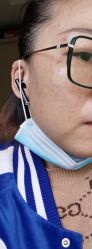 -爱莎扁平疣·汗管瘤·斑痣中心