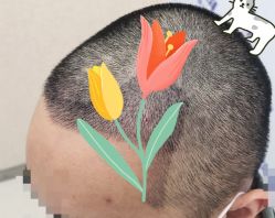 -大麦微针植发全国连锁