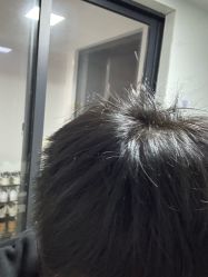 -大麦微针植发丨全国连锁