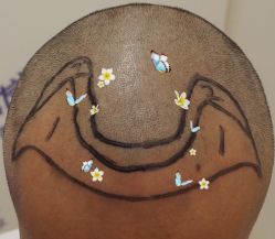 -大麦微针植发全国连锁