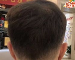 -大麦微针植发全国连锁