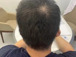 -大麦微针植发全国连锁