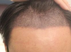 -大麦微针植发全国连锁