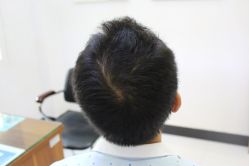 -大麦微针植发丨全国连锁