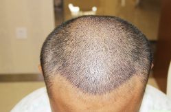 -大麦微针植发丨全国连锁