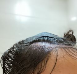 -碧莲盛·不剃发植发