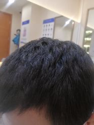 点击看大图 -碧莲盛·不剃发植发
