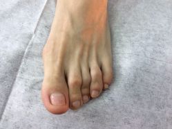 点击看大图 -德哥灰指甲脚气甲沟炎跖疣护理