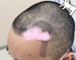 -大麦微针植发全国连锁