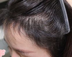 -大麦微针植发丨全国连锁