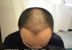 -大麦微针植发全国连锁