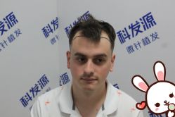 点击看大图 -大麦微针植发丨全国连锁