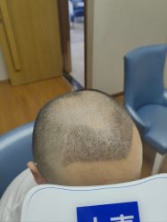 -大麦微针植发全国连锁