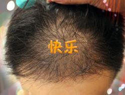 -大麦微针植发全国连锁