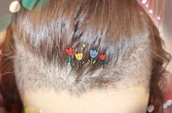 -大麦微针植发全国连锁