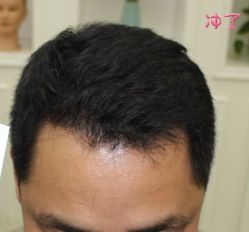 -大麦微针植发丨全国连锁