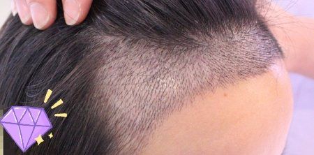 -大麦微针植发丨全国连锁