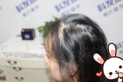 -大麦微针植发丨全国连锁