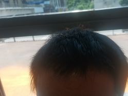 -碧莲盛·不剃发植发