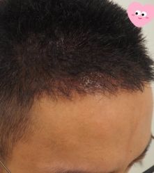 -大麦微针植发丨全国连锁