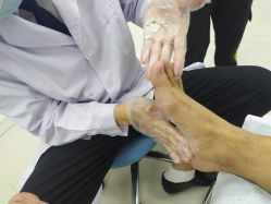 -派恩宜灰指甲鸡眼嵌甲手足癣