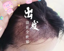 -大麦微针植发全国连锁