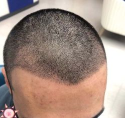 -大麦微针植发丨全国连锁