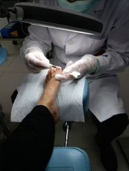 -派恩宜灰指甲鸡眼嵌甲手足癣