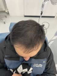 -大麦微针植发全国连锁