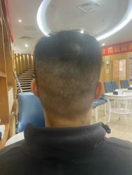 点击看大图 -大麦微针植发全国连锁