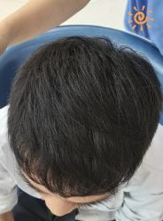 -大麦微针植发丨全国连锁