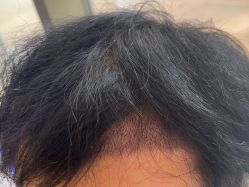 -碧莲盛·不剃发植发