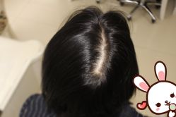 -大麦微针植发丨全国连锁