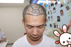 点击看大图 -大麦微针植发丨全国连锁