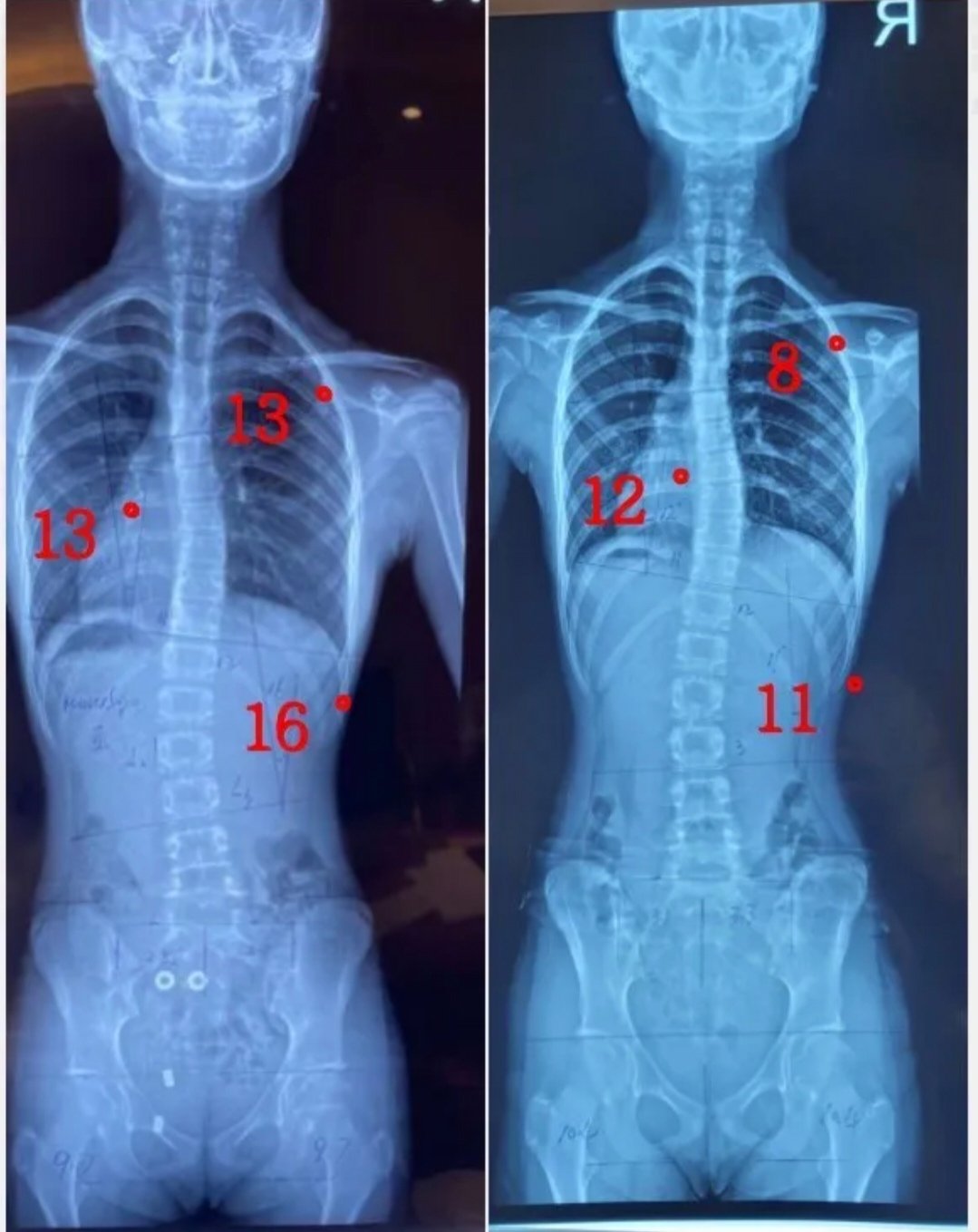 正常人体脊椎x光片图片