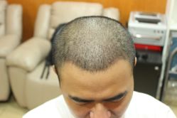 点击看大图 -大麦微针植发丨全国连锁