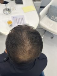 -大麦微针植发全国连锁