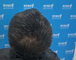 -雍禾植发