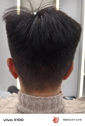 体验后-大麦微针植发全国连锁