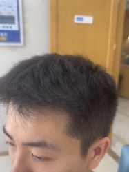 点击看大图 体验后-大麦微针植发丨全国连锁