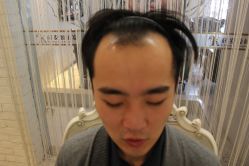 点击看大图 -大麦微针植发丨全国连锁