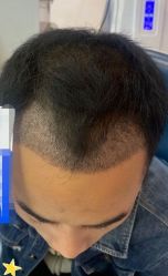 -大麦微针植发丨全国连锁