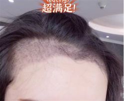 -大麦微针植发全国连锁