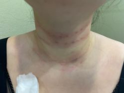 体验后-郡艺医疗美容·微整·眼鼻吸脂