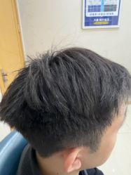 -大麦微针植发丨全国连锁