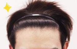 -大麦微针植发丨全国连锁