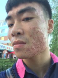 -风云专祛痘全国连锁机构