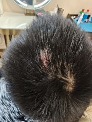 -碧莲盛·不剃发植发